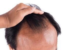 The Woes of Hair Loss