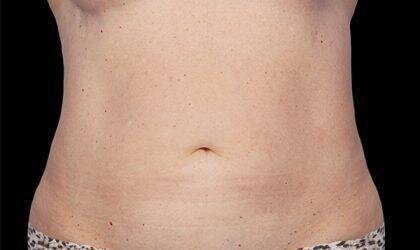 Is There an Age Limit for CoolSculpting?