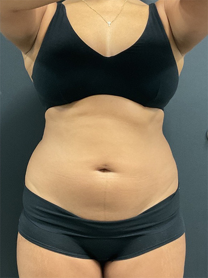 Abdomen Before & After Image