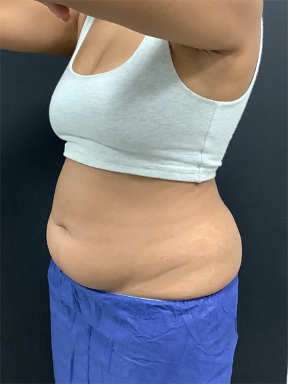 Abdomen Before & After Image