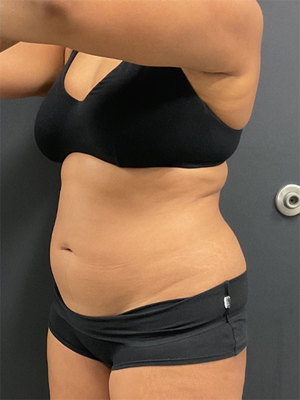 Abdomen Before & After Image