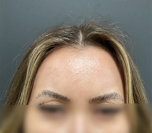 Botox Before & After Image