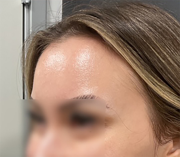 Botox Before & After Image