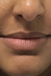 Lip filler Before & After Image