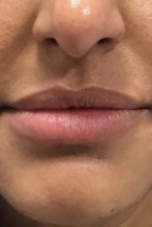 Lip filler Before & After Image