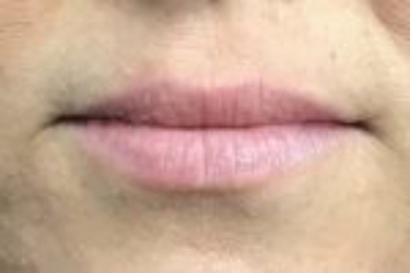 Lip filler Before & After Image