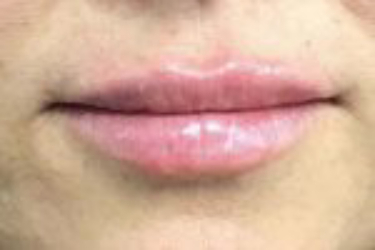 Lip filler Before & After Image