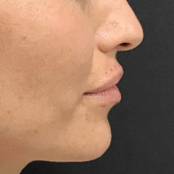 Lip filler Before & After Image