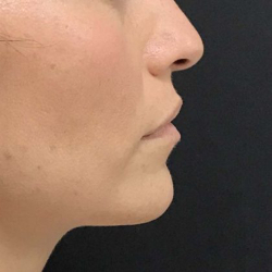 Lip filler Before & After Image