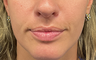 Lip filler Before & After Image