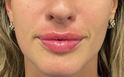 Lip filler Before & After Image
