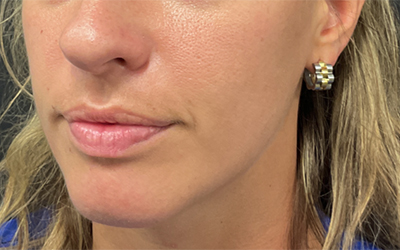 Lip filler Before & After Image