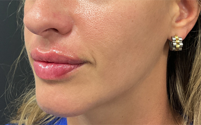 Lip filler Before & After Image