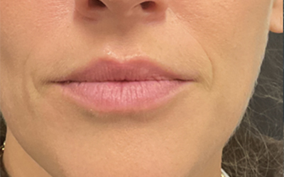 Lip filler Before & After Image
