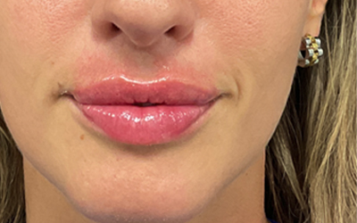 Lip filler Before & After Image