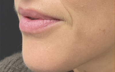 Lip filler Before & After Image