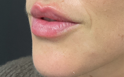 Lip filler Before & After Image