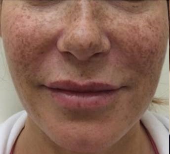 Lumecca ipl Before & After Image