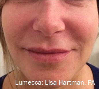 Lumecca ipl Before & After Image