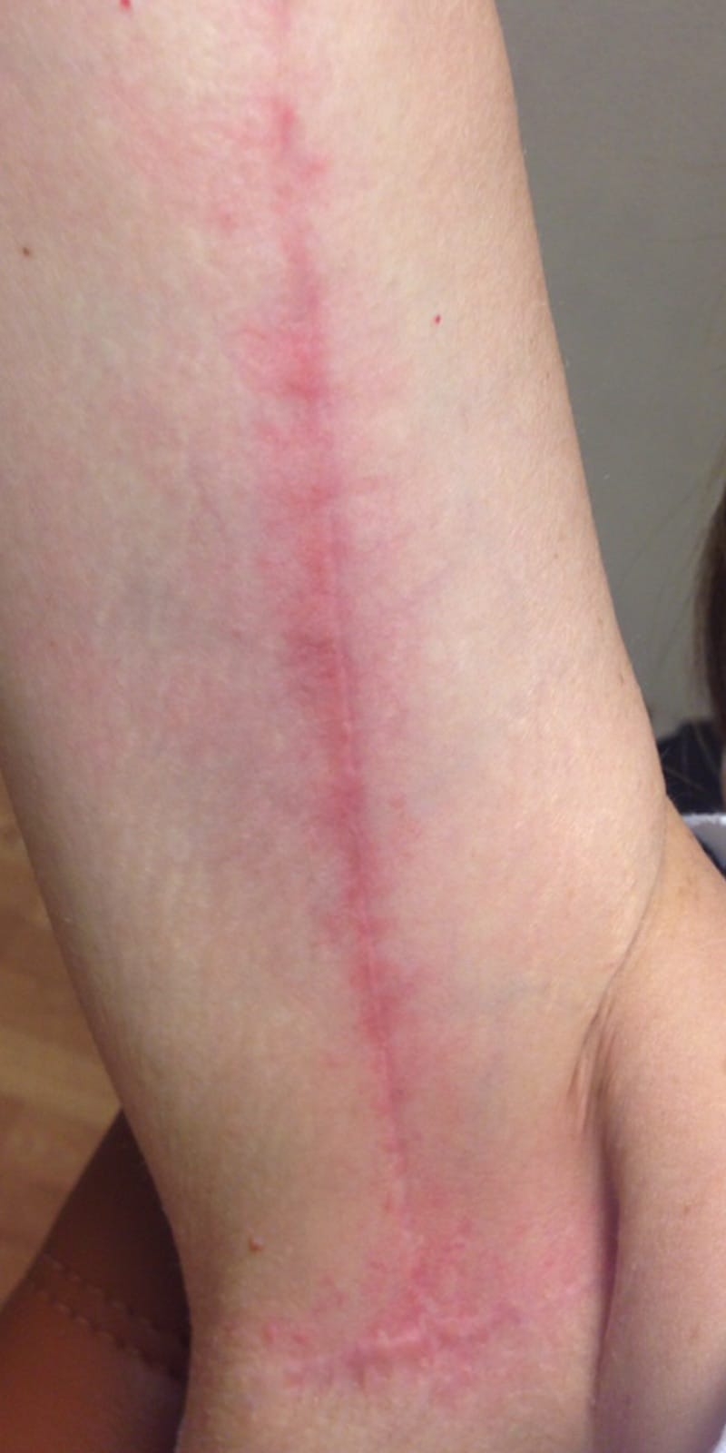 Lumecca ipl Before & After Image