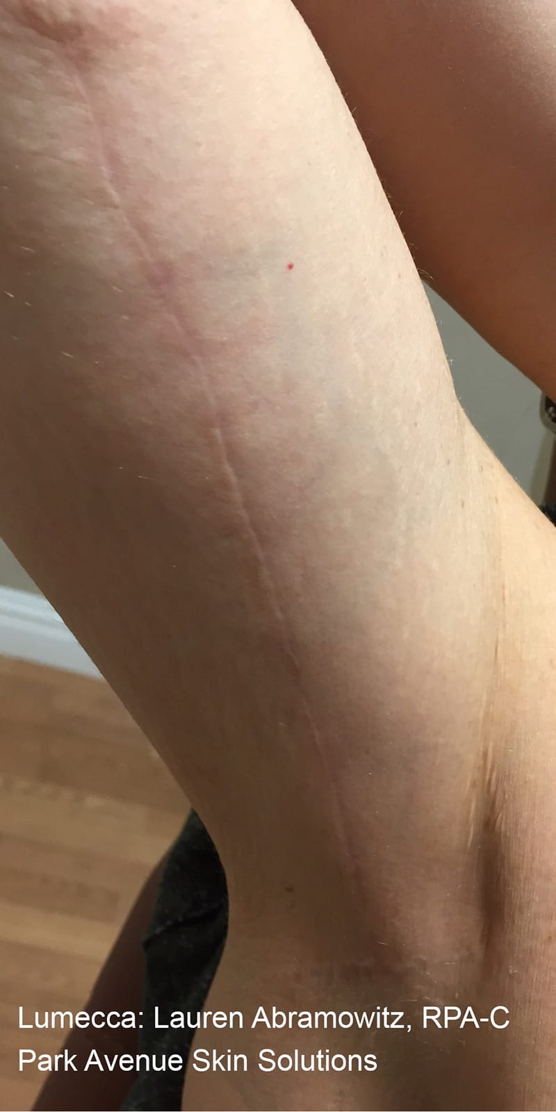 Lumecca ipl Before & After Image