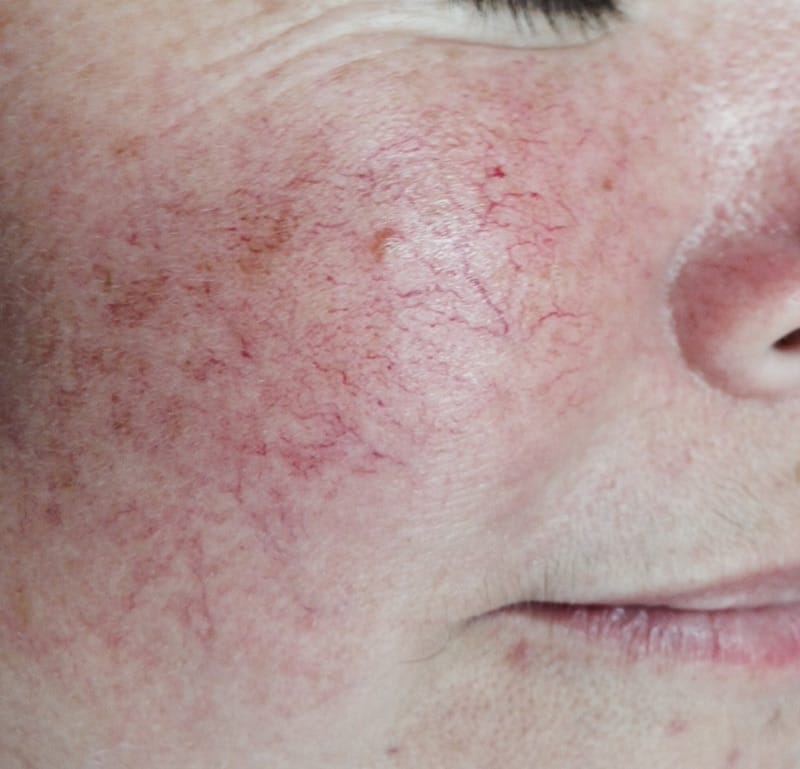 Lumecca ipl Before & After Image