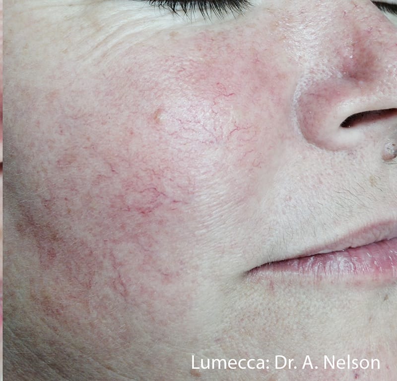 Lumecca ipl Before & After Image